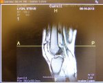 Co to jest artroskopia stawu kolanowego?